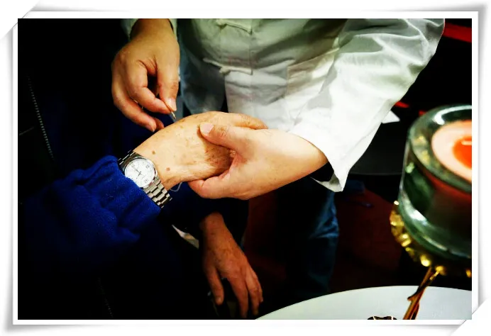 Acupuncture treatment detail
